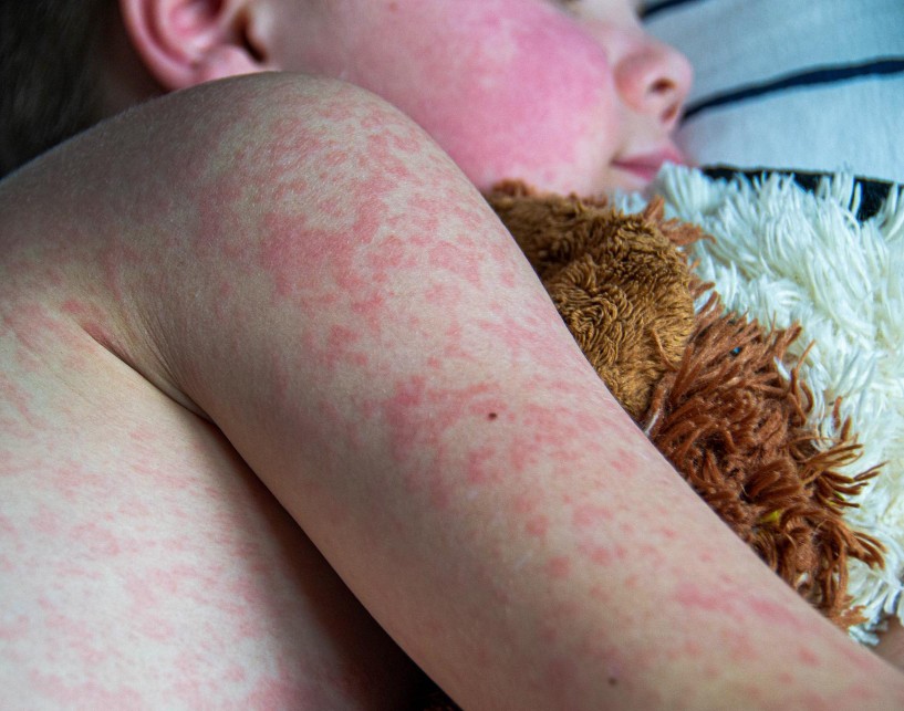 Vaksin Campak Sudah Terdistribusi ke 7 Daerah di Sulsel, Kasus Melandai